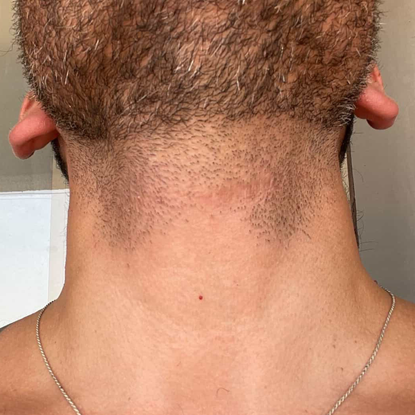 Cuello antes