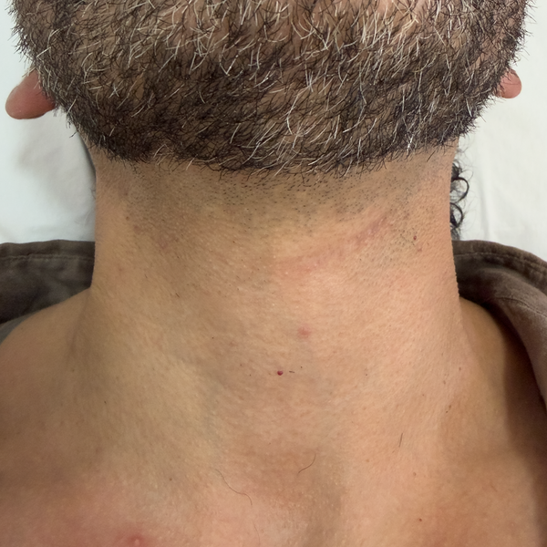 Cuello después