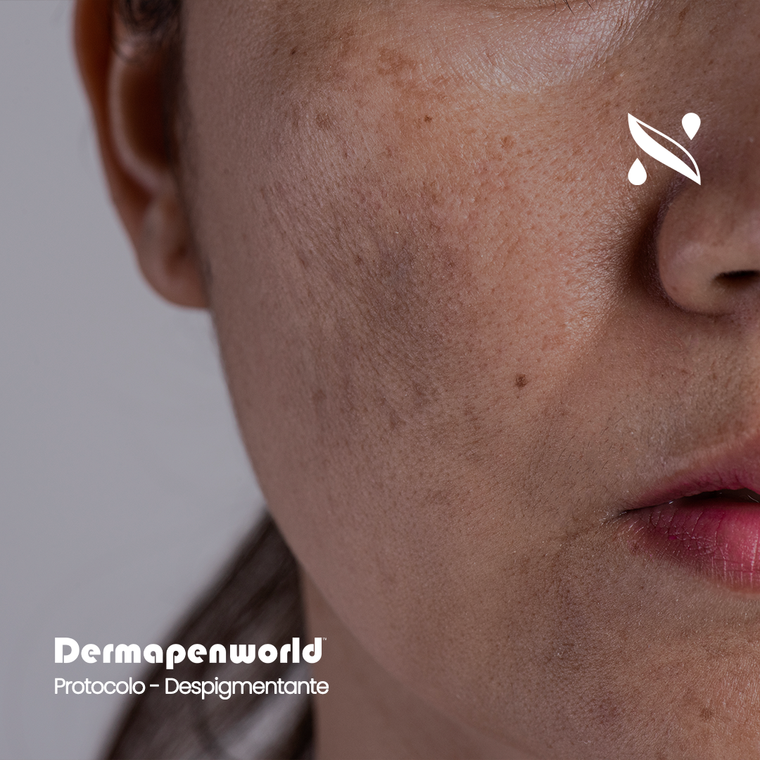 Dp-Despigmentante