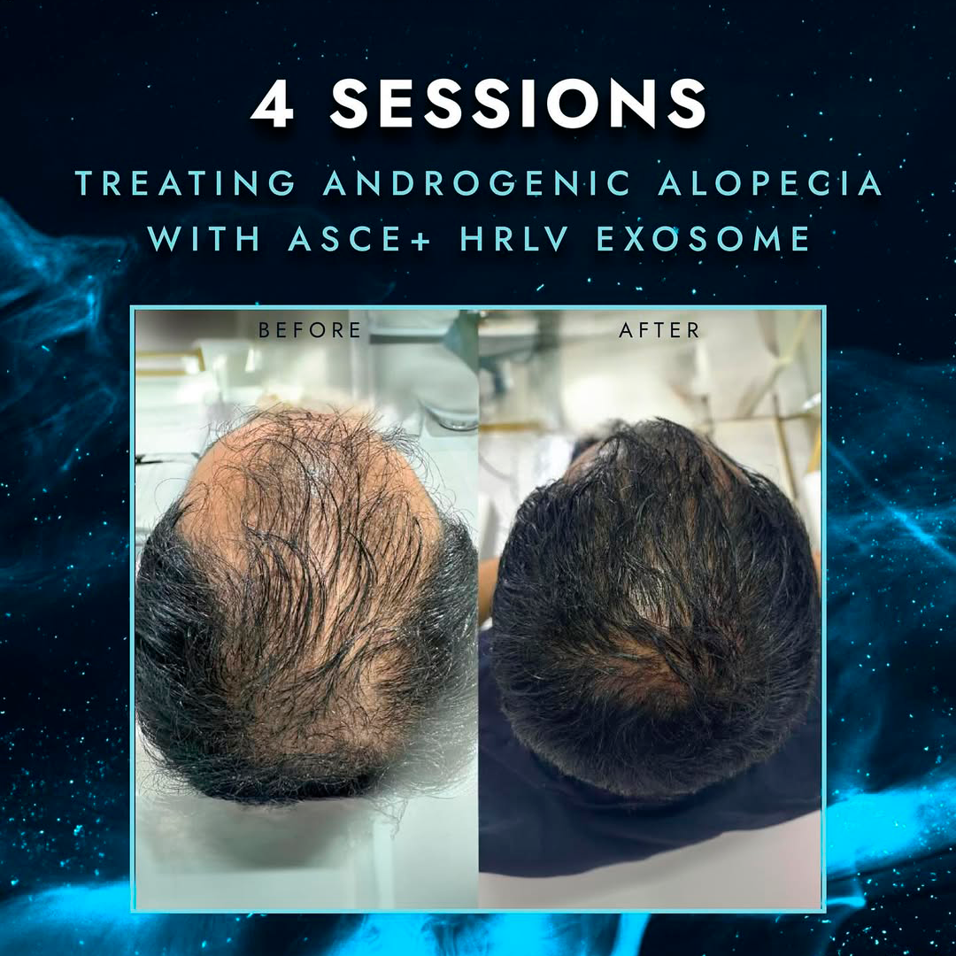 Exosomas-ASCE-Plus-HRLV-2