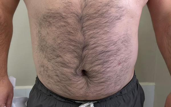 Abdomen antes