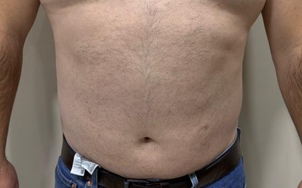 Abdomen después