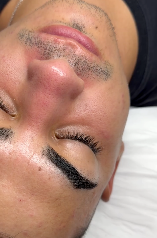 Limpieza Facial Profunda - Acné