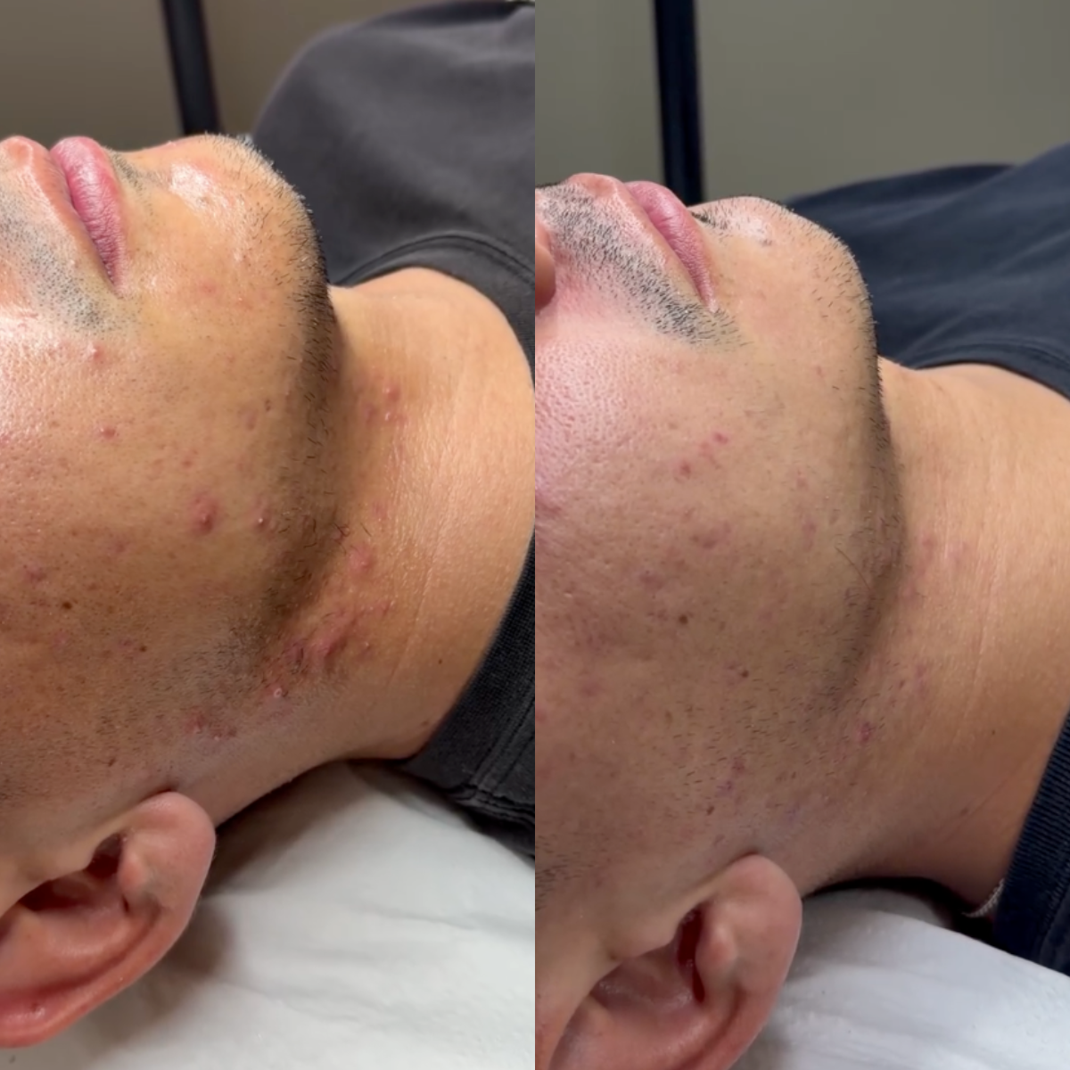 Limpieza Facial Profunda - Acné