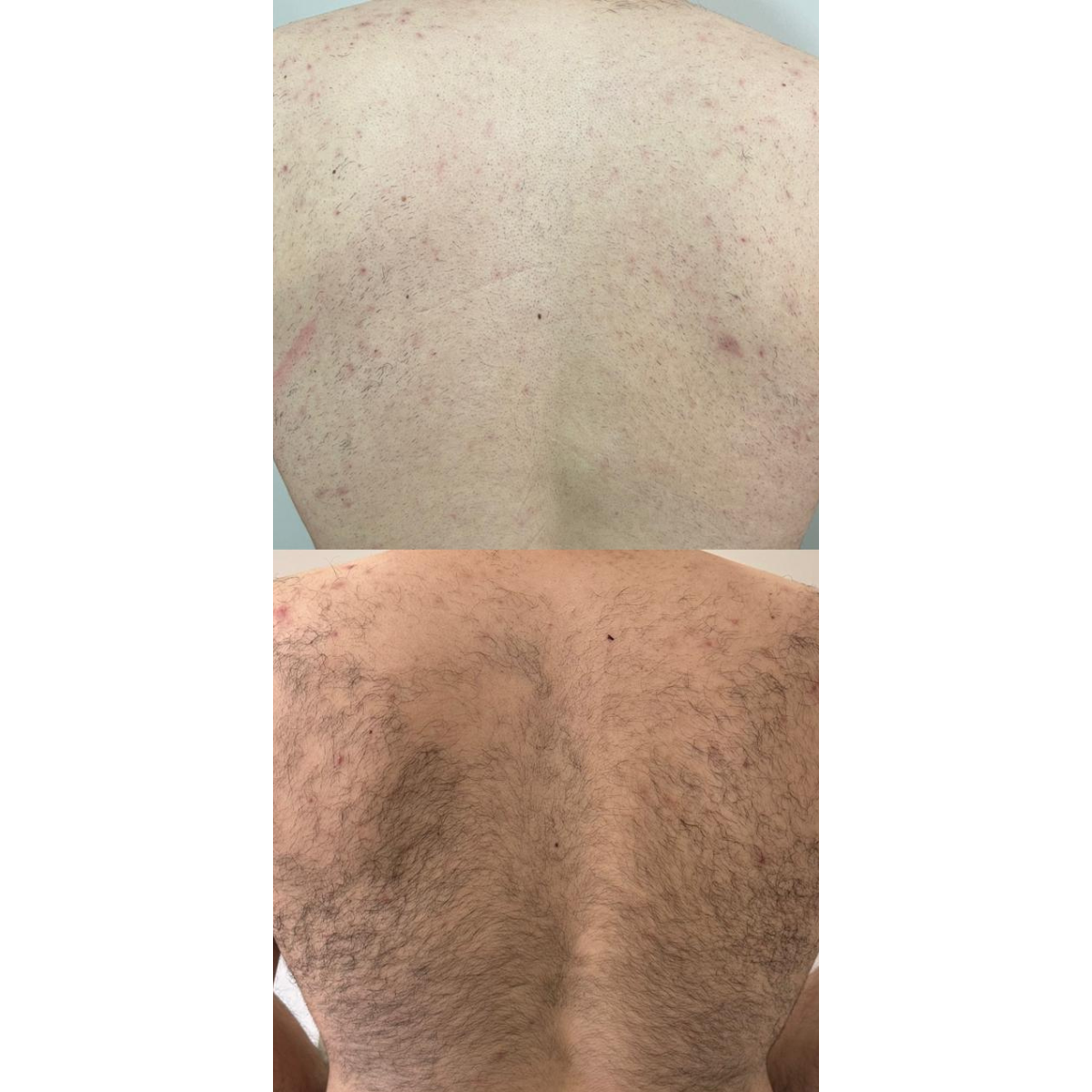Espalda completa 6 Sesiones Hombre